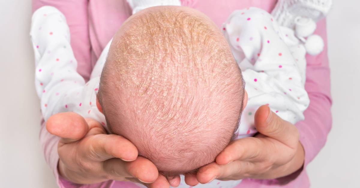 Mi bebé tiene caspa: ¿a qué se debe?