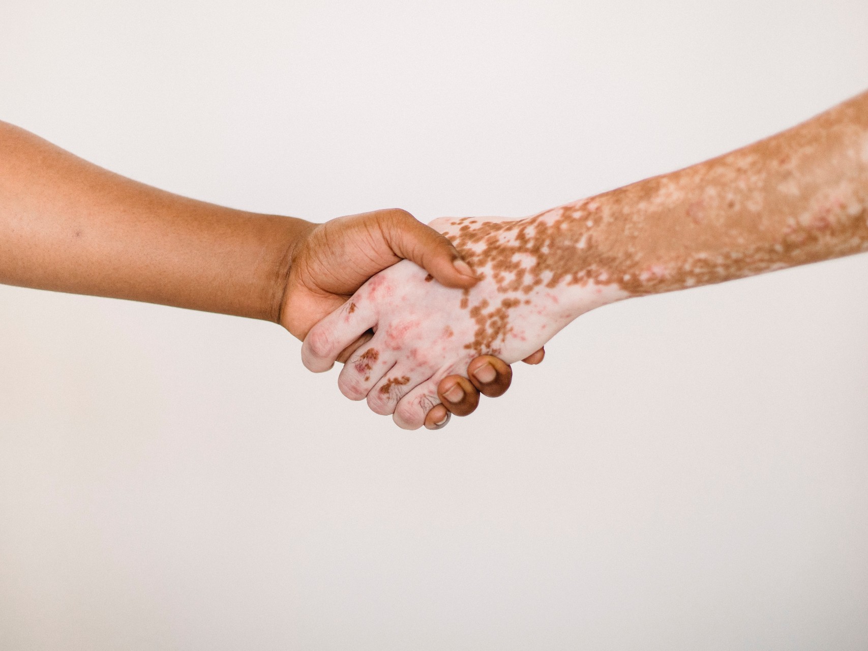 vitiligo