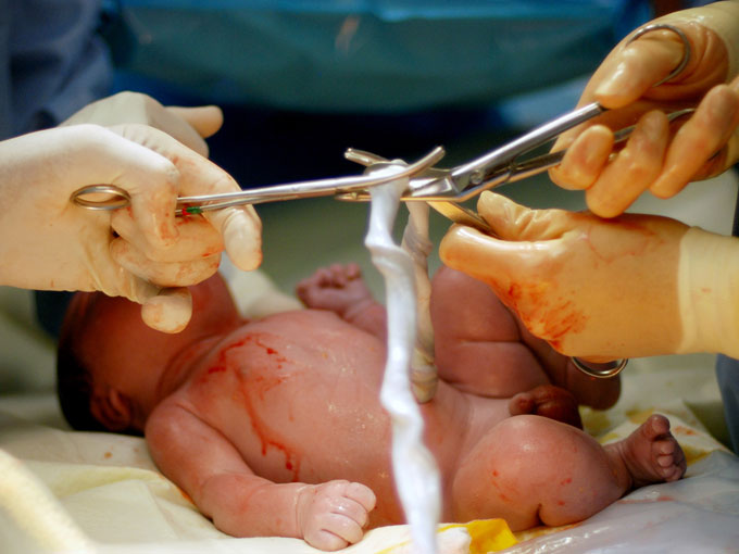 La OMS recomienda esperar 3 minutos a cortar el cordón umbilical
