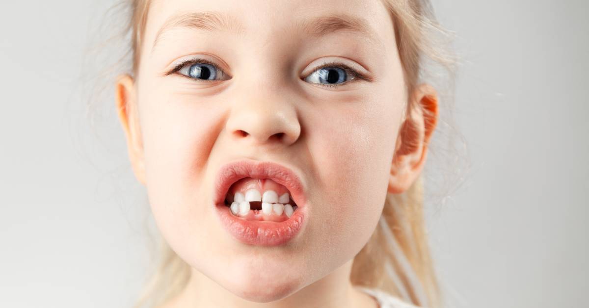 Consecuencias de arrancar un diente de leche del niño