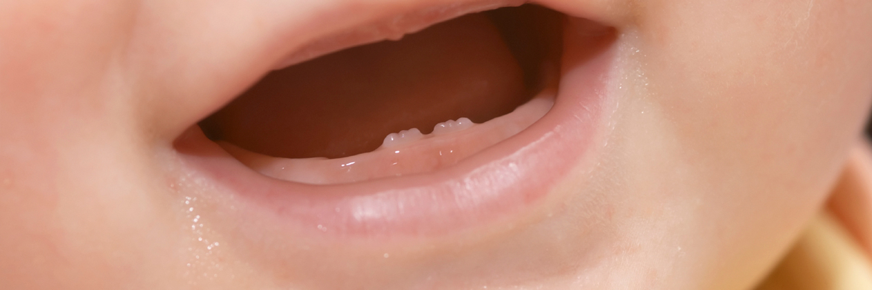 Muguet: qué es la candidiasis oral en niños