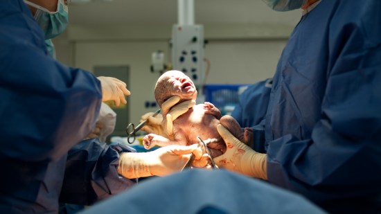 Riesgos de una cesárea para la madre y para el bebé