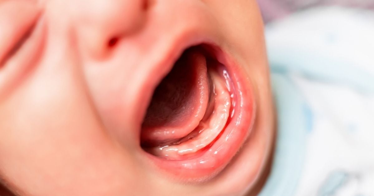 Problemas que puede causar el frenillo lingual, según la edad del niño