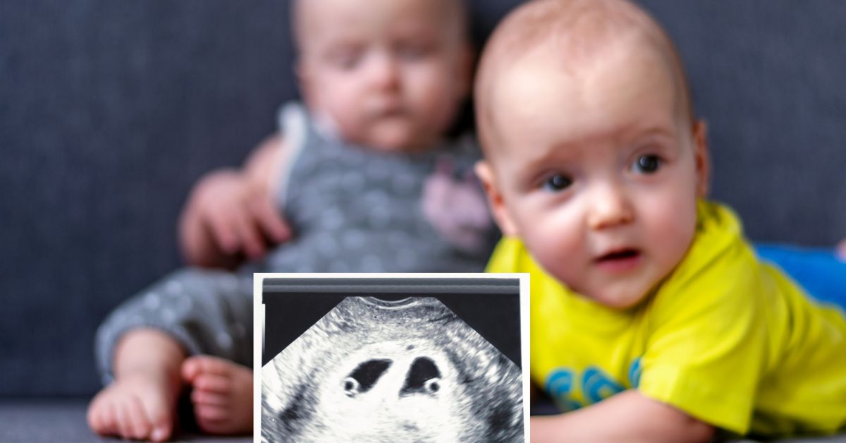 ¿Qué es la superfertilización? Cuáles son las causas de la superfecundación heteropaternal