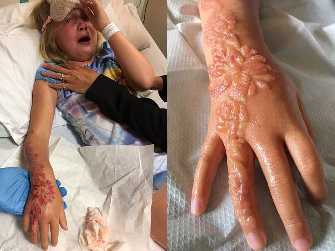 ¡Cuidado con los tatuajes de henna en los niños!