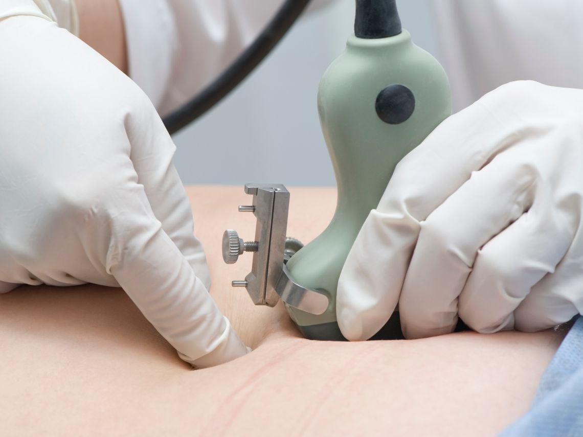 Prepararse para una amniocentesis