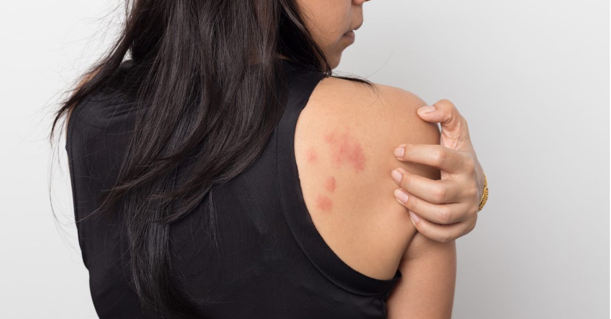 Urticaria en el embarazo: causas, tratamiento y cómo aliviarla
