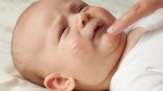Mi peque tiene dermatitis atópica
