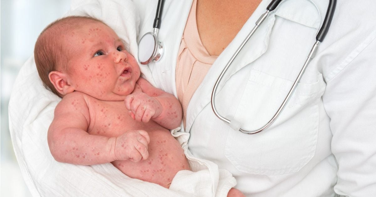 Herpes en bebés: ¿por qué se producen y cómo tratarlos?