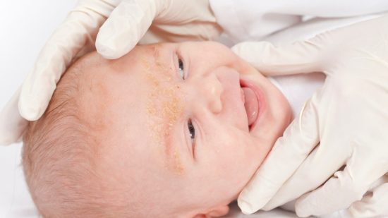 Dermatitis seborreica del bebé