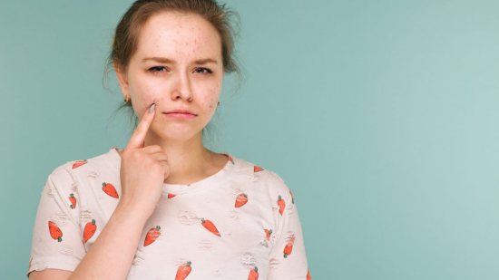 Acné del embarazo: qué es, causas y cómo tratarlo