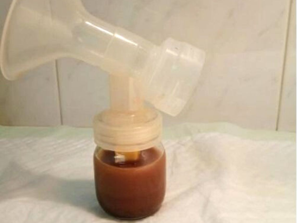 Síndrome de las tuberías oxidadas
