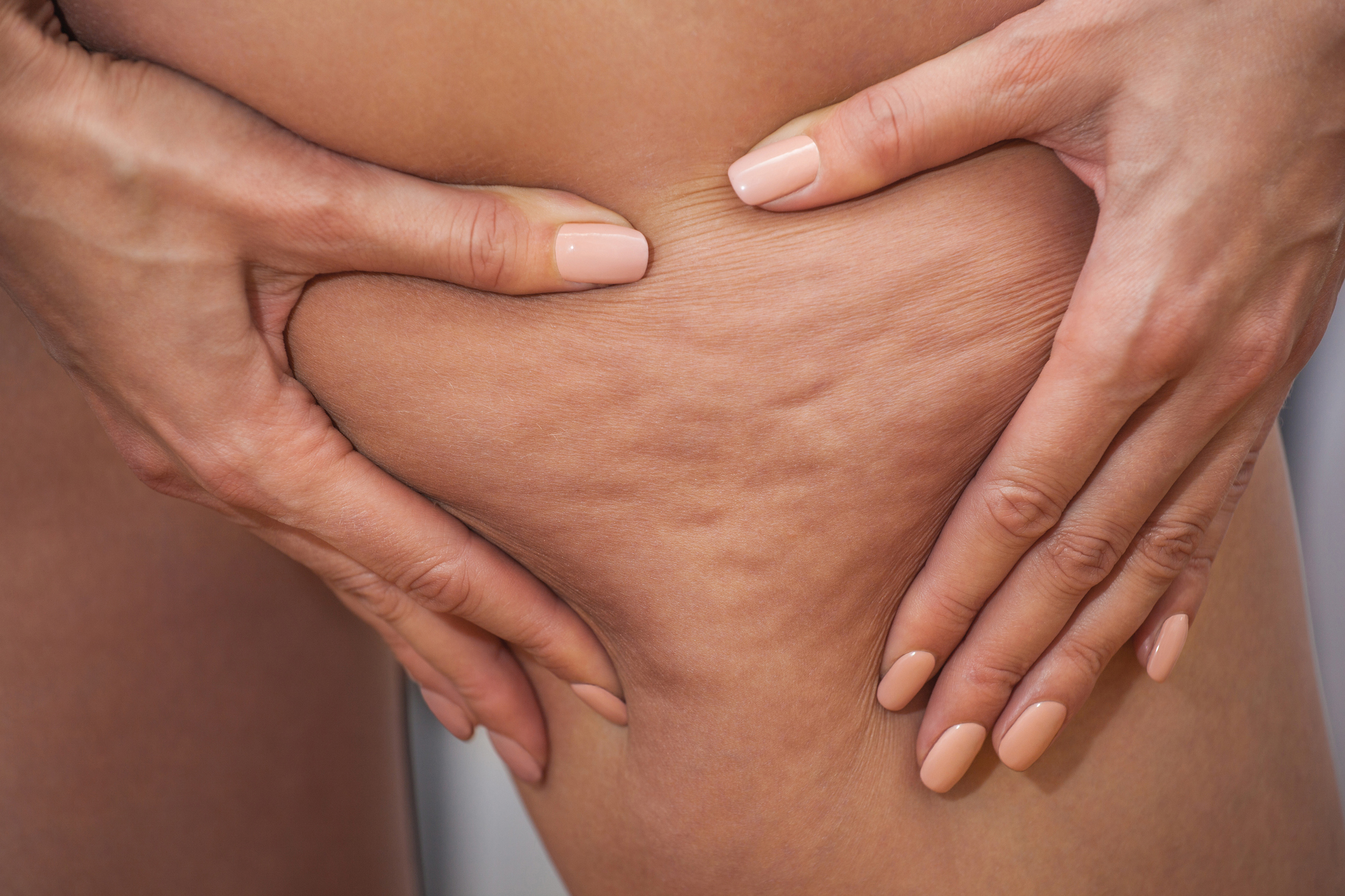 Celulitis
