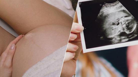 Endometriosis y fertilidad