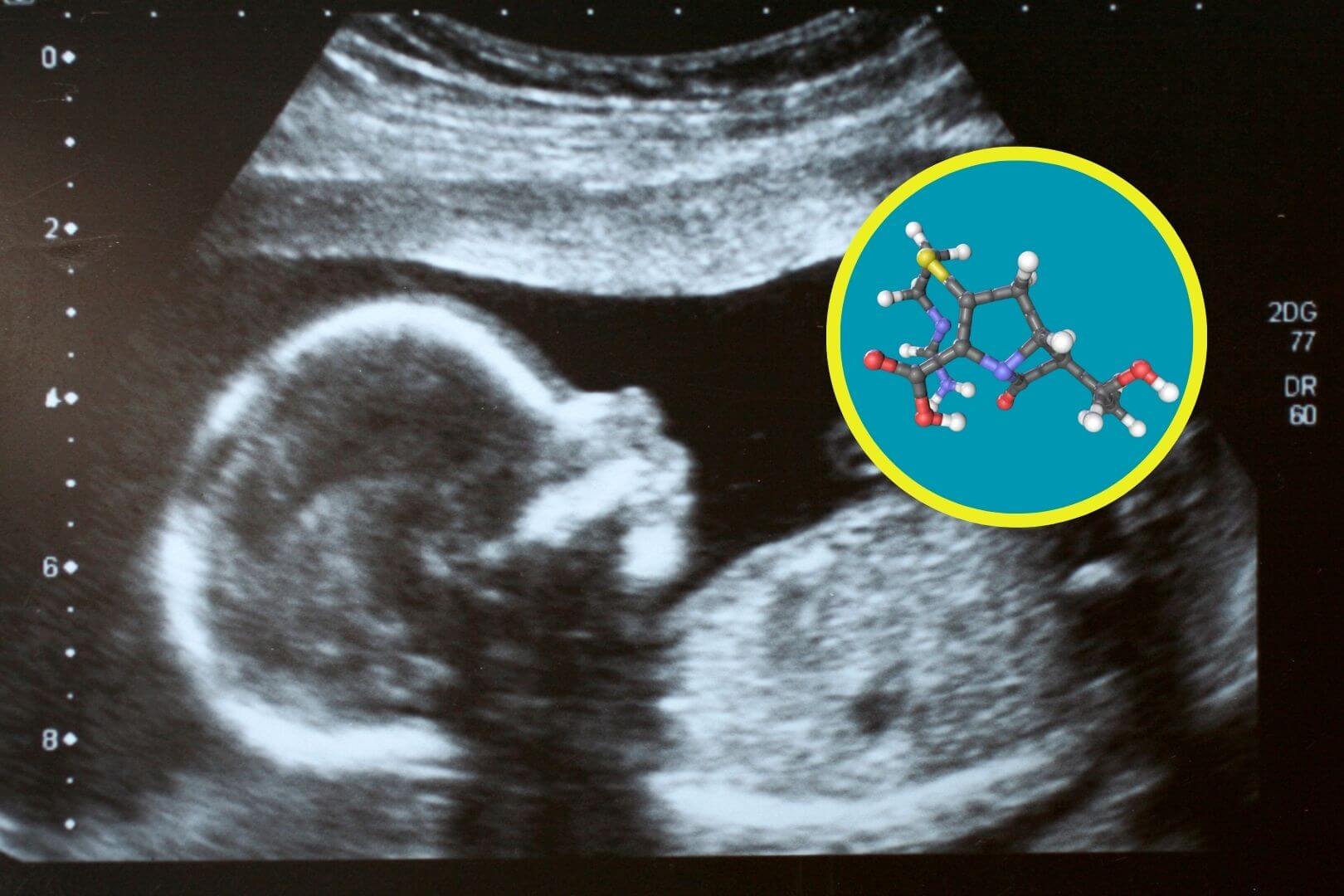 La historia detrás del primer uso prenatal de un medicamento para la atrofia muscular espinal