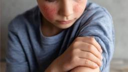 Niño con rojeces en la piel y rascándose el brazo debido al picor, posible reacción cutánea común en la infancia.